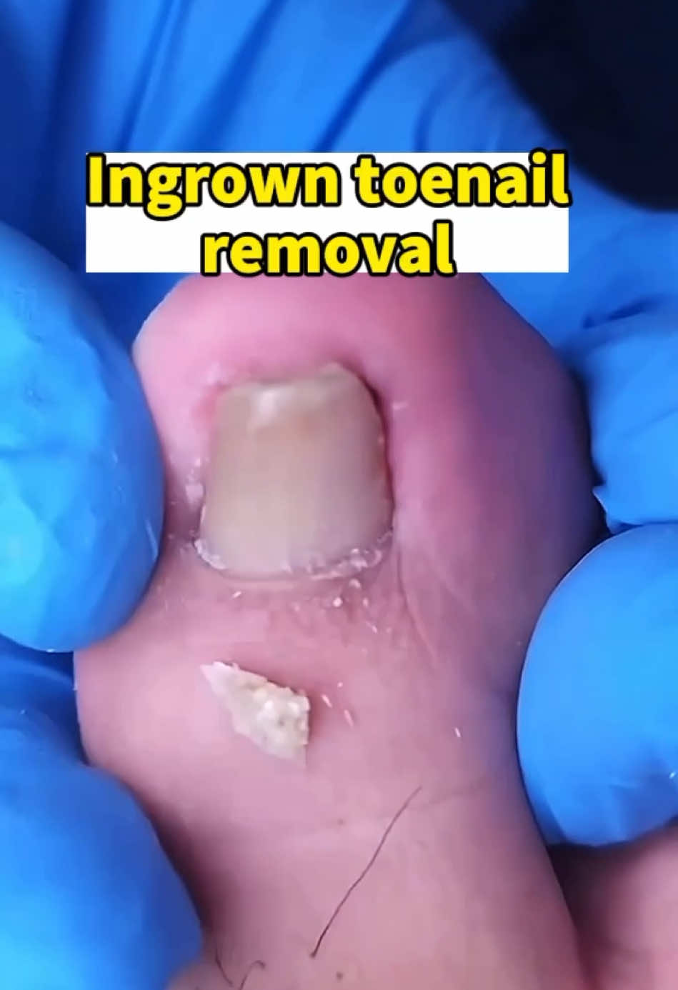 Ingrown toenail removal #ingrowntoenail #toenailremoval #viralvideo #ingrowntoenailremoval #toenails #pedicure #foryou #fyp