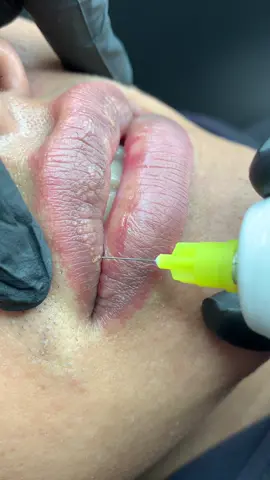 Plasma xoá hạt fordyce cho môi nam #nhiphunxam #khuthammoinam #xoahatfordyce #65cantho 