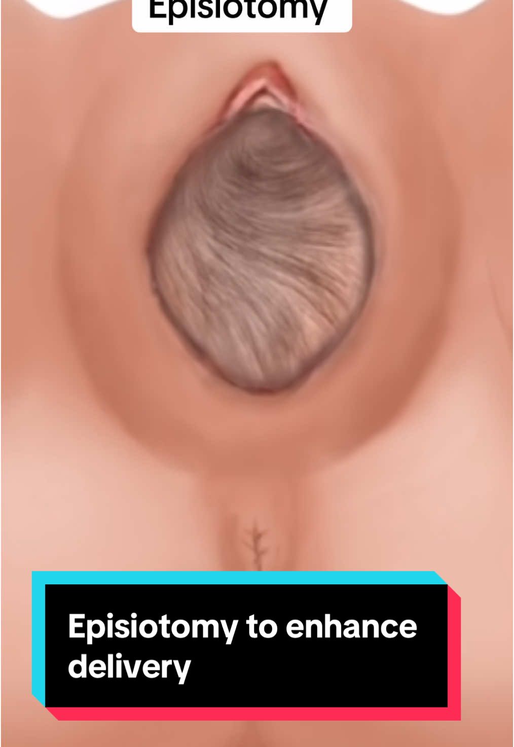 Episiotomy enhances delivery of the baby and to prevent complications#creatorsearchinsights #episiotomy #labour #pregnant #pregnancy#baby #mrsmorganj #firsttimemom 