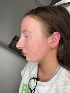 Non surgical nose job results 👃🏼 If you are someone who is wanting a nose job, have you ever thought about dermal fillers first?  Liquid rhinoplasty means instant results with little down time at a fraction of the price. #liquidrhinoplastyleeds #aestheticspractitioner #russianlips #dermalfillers #aestheticsleeds 