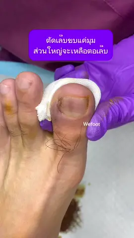 ตัดเล็บขบออกแค่มุมเล็บมีโอกาสเหลือตอเล็บ#ingrowntoenail #wefootตัดเล็บขบรักษาเล็บเชื้อรา #ตัดเล็บขบมียาชา #เล็บขบ #เล็บขบหนักมาก #ตัดเล็บขบ #เล็บขบอักเสบ 