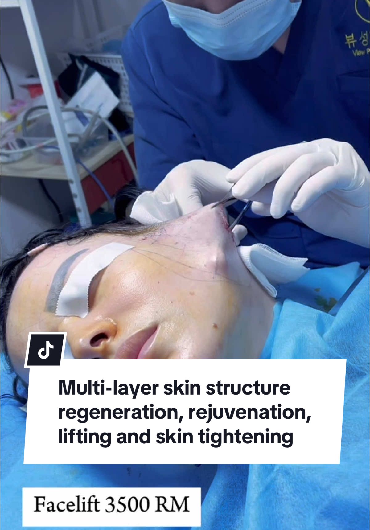Multi-layer skin structure regeneration, rejuvenation, lifting and skin tightening#cosmeticsurgery #fyp #facelift #kualalumpur #malaysia #tiktokmalaysia🇲🇾 #dryangkim 