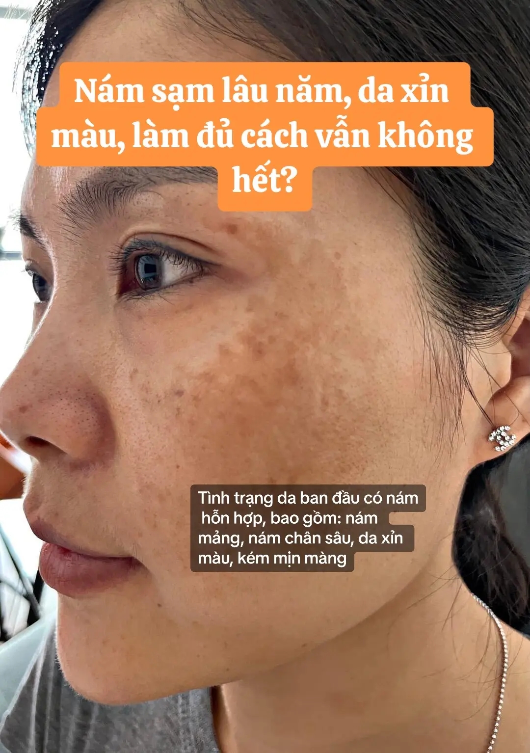 #hangtrinam #trinamtannhang #namda #peelda #laserco2 #trinamhieuqua #nam