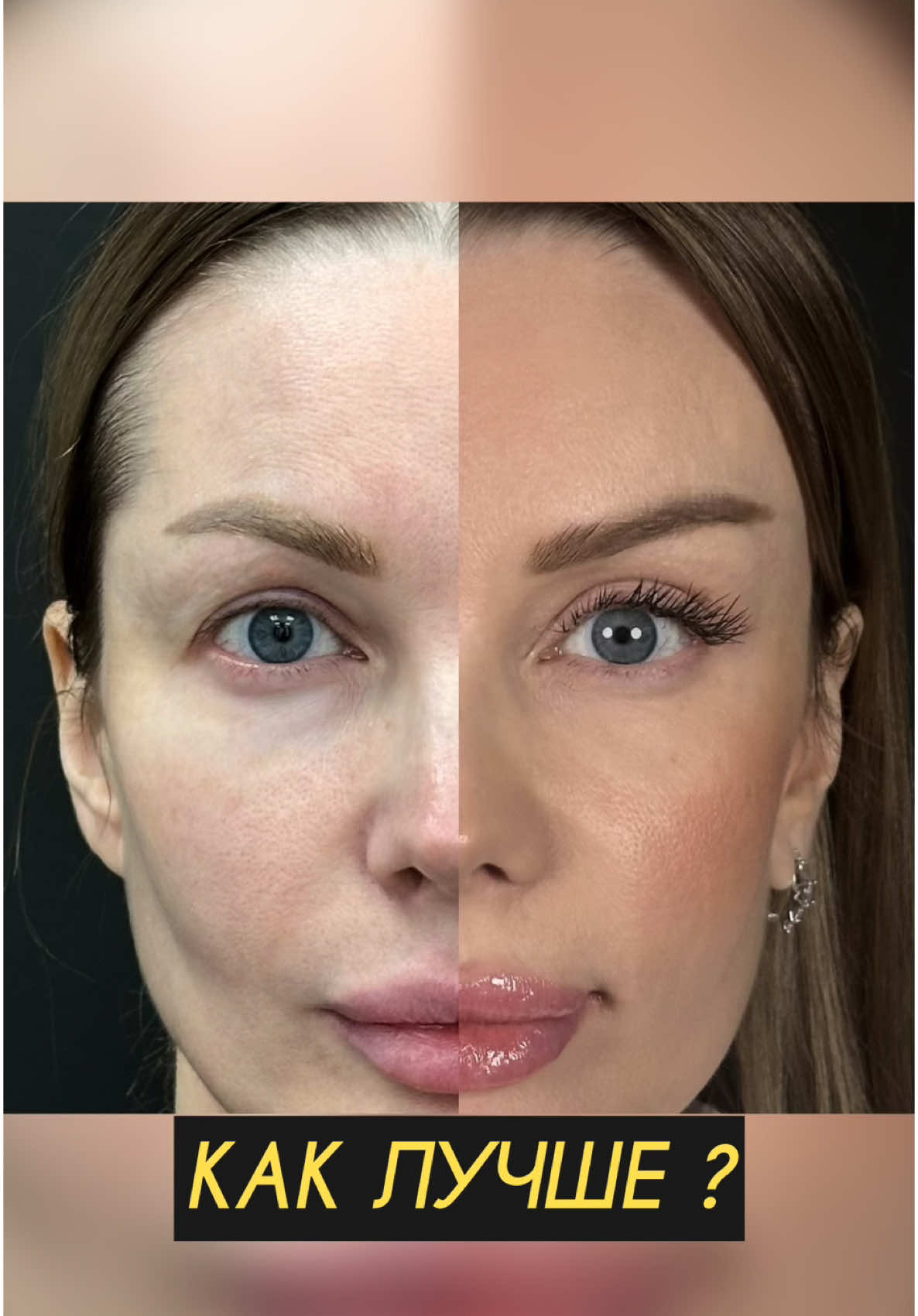 Прошло пара месяцев с момента операции.  ⚡️ Эндоскопическая подтяжка висков и блефаропластика верхних век