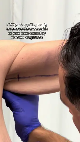 Massive weight loss often times means excess skin. Our Revive XLift is gold standard for high BMI patients and those looking to remove excess skin.  #revivexlift #plasticsurgery #surgeon #armlift #brachioplasty 