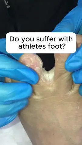 Tired of athlete feet? Use this! Say goodbye to the stink and the itch!
