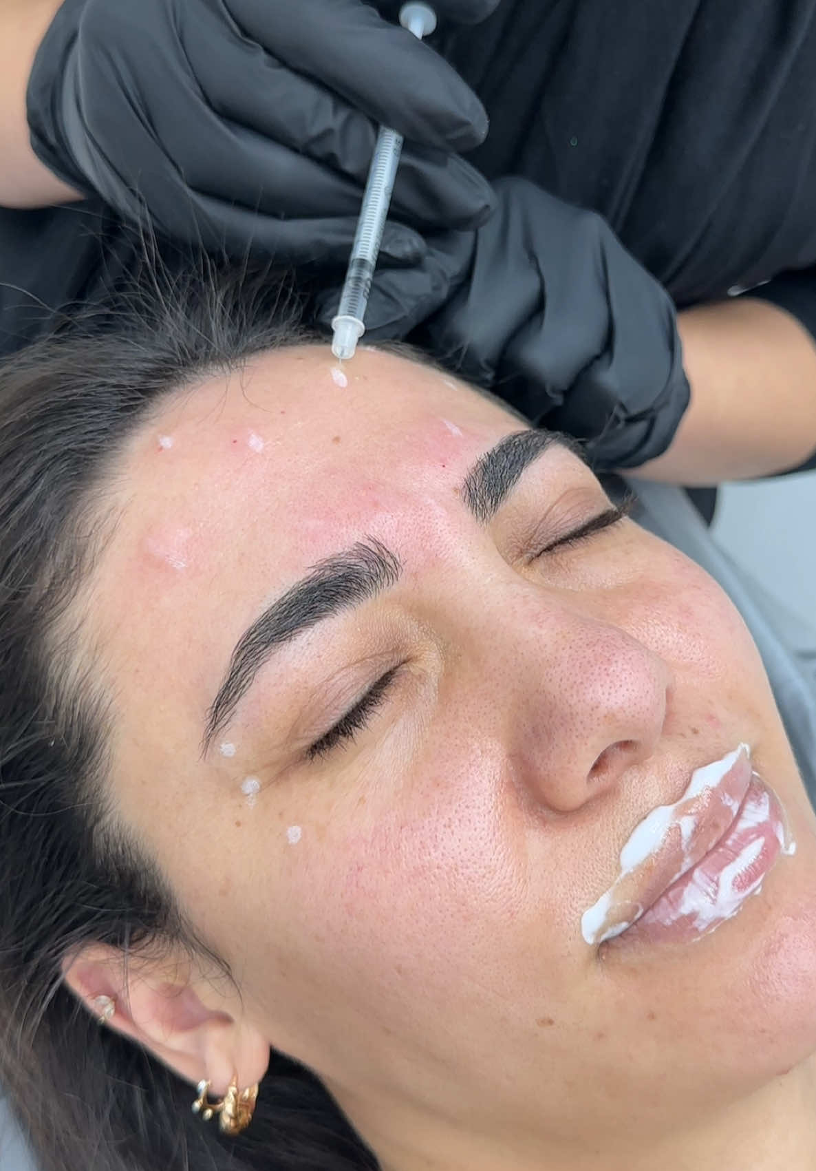 We loooove BTX 😍✨ #botox #botoxnatural #botoxlondon #fyp #russianlipslondon #russianlips #lipfillerslondon #lipfiller 