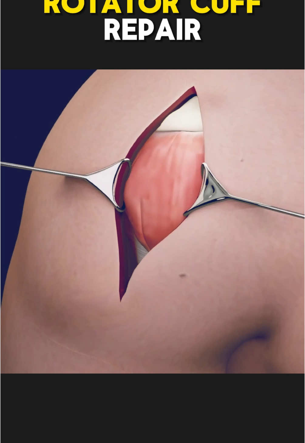 Rotator Cuff Repair Surgery (3D Animation) #rotatorcuff #rotatorcuffinjury #rotatorcufftear #rotatorcufftearsurgery #rotatorcuffsurgery #rotatorcuffrepairsurgery #rotatorcuffrepair #medical3danimation #3dmedicalanimation 