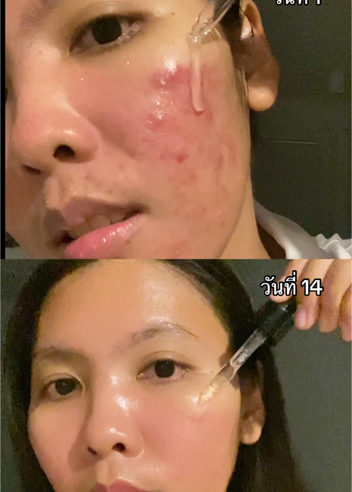 รีวิวลดรอยสิวจางไว ฉบับคนเป็นสิวแพ้ง่าย #เมเบลมารีวิว #ลดรอยดํารอยแดงจากสิว #เซรั่มลดรอยสิว #เซรั่มมานูก้า #ลดรอยสิว #รอยสิวจางไว 