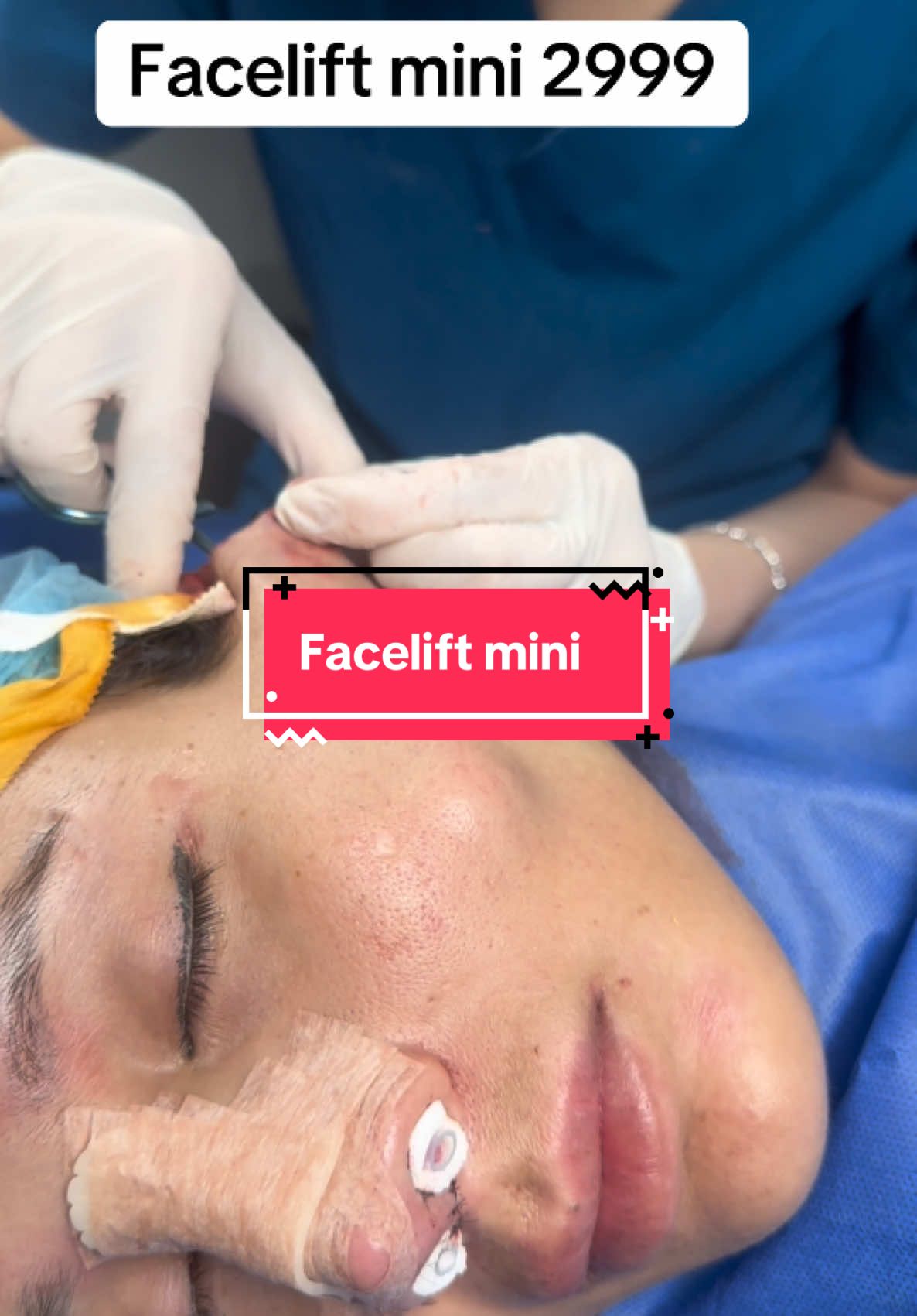 Facelift mini #facelift #rhinoplasty #hidung #tiktokmalaysia #indonesia #implant #tiktokmalaysia🇲🇾 #tiktokmalaysia🇲🇾 #ybt #tiktokviralvideo #tiktokviral #malaysia #malaysia #tiktokindonesia 
