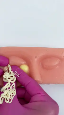 Treatment pimple eye-area the most relaxing. Satisfying? #siliconemodel #capcut #howtomakepimples #acnetreatment #asmrtiktoks #asmr #viralvideo #fypシ #pimple #pimplepopping #pimple_popper_asmr #tingles #asmrtingles #asmrtriggers #artificialskin #oddlysatisfying #relaxingcontent #skincaretips #asmrsounds #usa #eyespimples #mochipimplepopping #bonniepimplepopperasmr 
