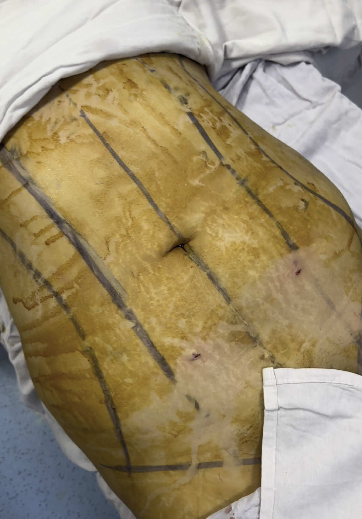 Resultado de Lipo + abdomino 