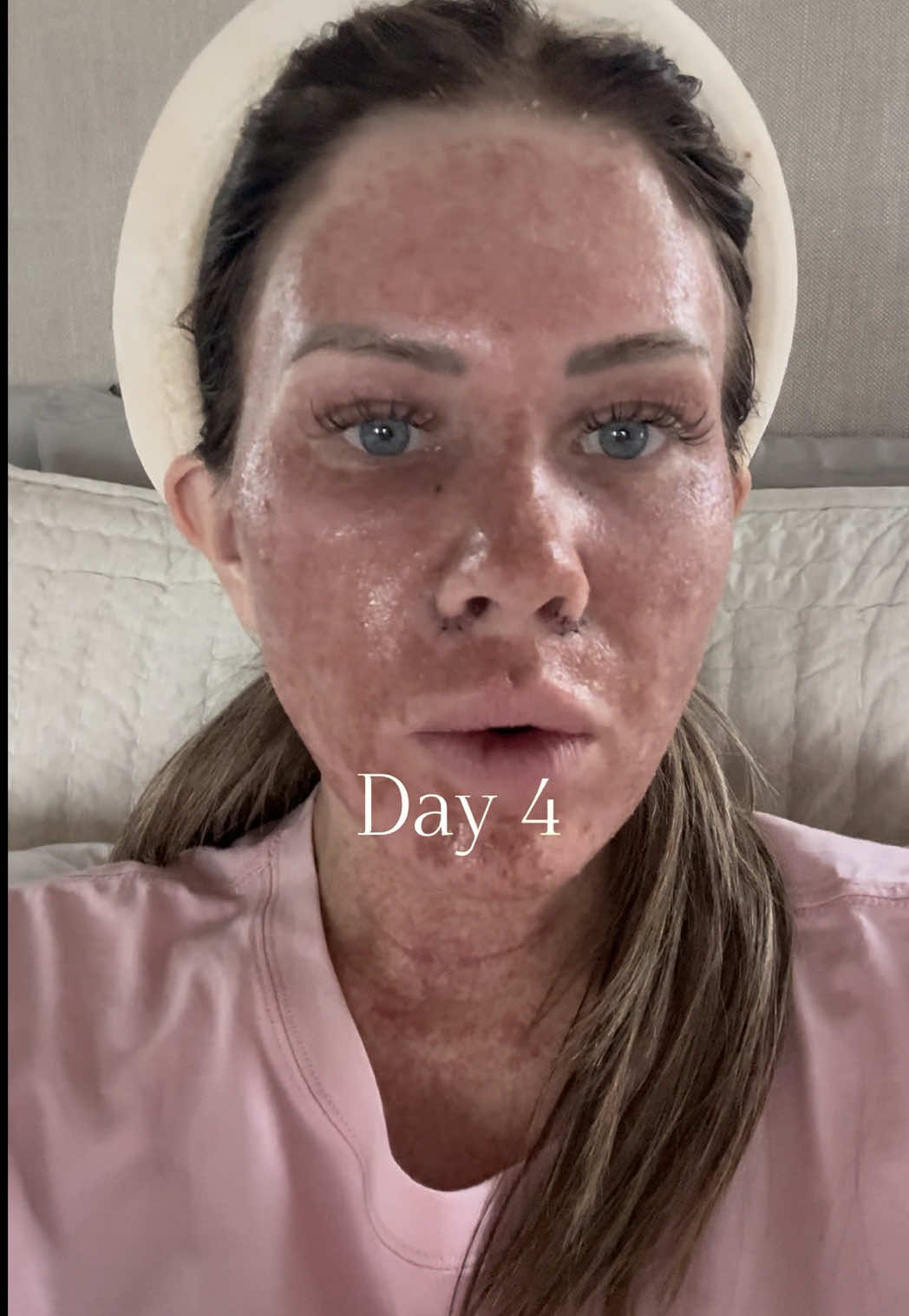 Day 4 is the first day I’m seeing some changes & improvements! @steele.md  #co2laserskinresurfacing 
