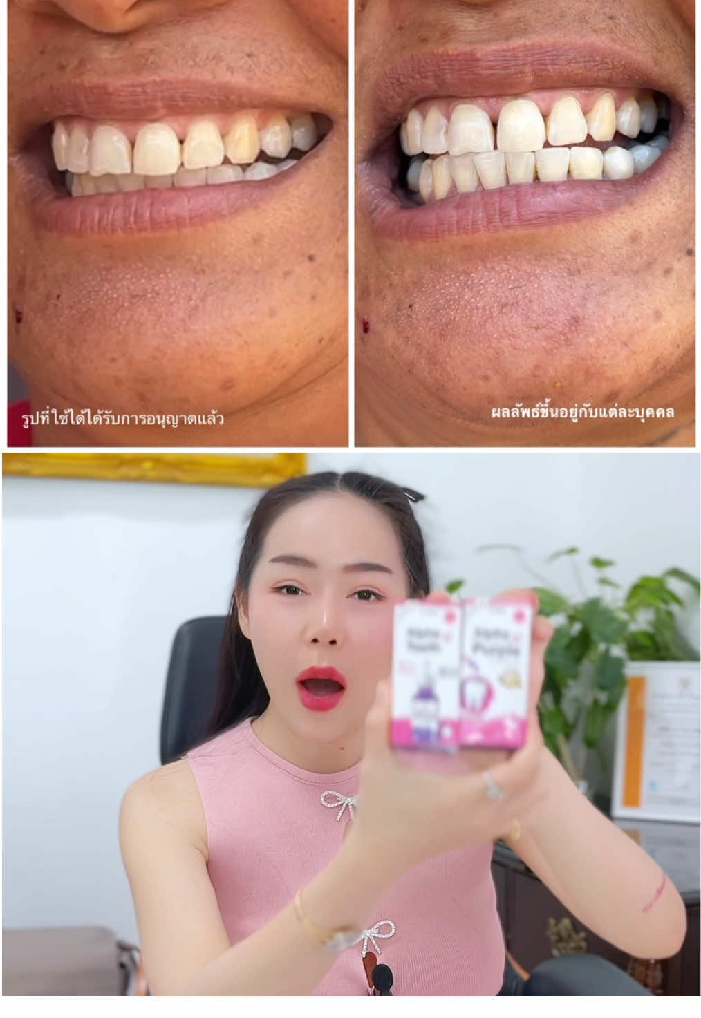 อยากฟันขาว ยาสีฟันตัวเดียวอาจไม่เพียงพอ‼️ #alphapurple #alphateeth #เซรั่มฟอกฟันขาว #เซรั่มฟอกฟันขาวไคร่า #ฟันขาว #ลดกลิ่นปาก #เซรั่ม 