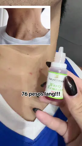 Skintags,mole,milia,siringoma,buni,anan pwede po ang kasoy oil #kasoyoil #wartsremover #naturesmiraclewartsremoval 