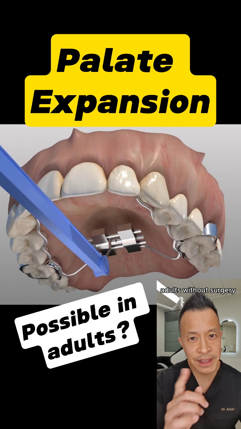 Palatal Expansion in Adults: Myth or Reality?  #dentallan #dentist #palatalexpander #expandingpalate #palatalexpansion #crossbite #adultteeth #palate #upperexpander #upperarch #orthodontics #oms #maxillofacial 