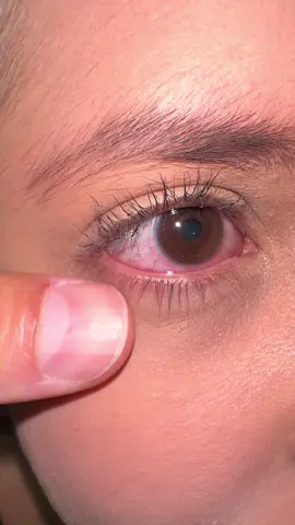 MAQUIAGEM no olho. Vale lembrar que essa remelinha tem outras causas, como por ex alergia ocular, poeira, coceira, blefarite. Siga e compartilhe essa informação  #eye #olho #curiosidades #ophthalmology #oftalmologia #oftalmologista #medicina #medico #medicine #ojos 