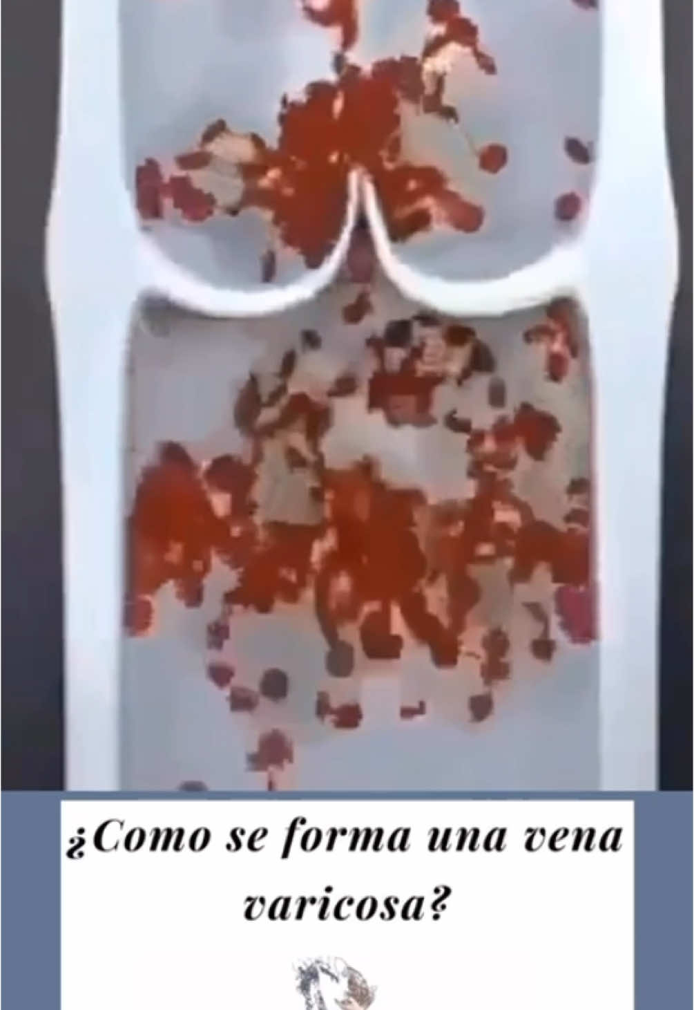 ¿Sabías que las várices se forman cuando las venas no funcionan correctamente? Las venas tienen válvulas que evitan que la sangre fluya hacia atrás. Sin embargo, cuando estas válvulas se debilitan, la sangre se acumula, haciendo que las venas se hinchen y se tornen visibles. Esto es lo que conocemos como várices. 💧 🔍 ¿Cómo se forma una várice? Vena normal: La sangre fluye correctamente gracias a las válvulas. Desgaste de las válvulas: Cuando las válvulas se debilitan, la sangre comienza a acumularse. Várice: Las venas se dilatan, se vuelven visibles y pueden causar molestias. 🔹 ¡Recuerda! Las várices son tratables y existen opciones para mejorar su apariencia y síntomas. ¡Consulta con un Angiologo y Cirujano Vascular son los expertos en el tema  #varicesenlaspiernas #varices #varicoseveins #