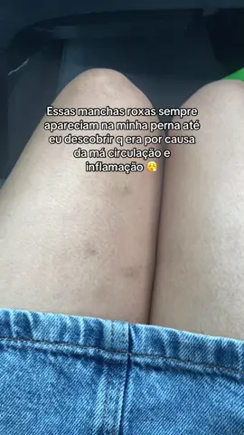 Amiga depois q comecei usar esse creme minha pele mudou bastante!!#lipedema #celulite #flacidez 