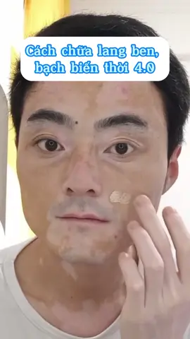 Cần gì phải trị lang ben bằng nhiều cách. Dùng ngay cái này là khỏi sạch