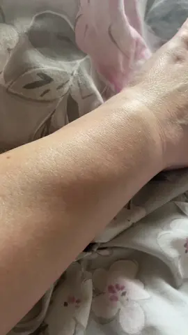 We’ve got all the swollen body parts going on this week.what a week it’s been#inflammation #swollen #swollenhandsandfeet #wrists #wristpain #arm #armpain #unwell #porley #sick #sickday #sickmode 