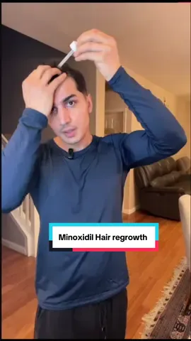 Minoxidil Hair regrowth Treatments. #minoxidil #haircare #afghantiktok #fypシ #tiktokshopping #tiktokshop 
