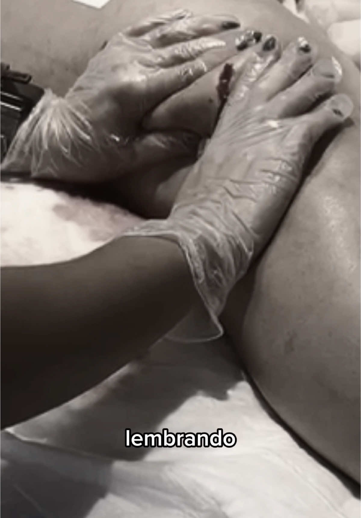 Quer saber como é o atendimento de lipoaspiração de lipedema, ainda no hospital?  Vou te mostrar tudo  #fisioterapia #fyppppppppppppppppppppppp #lipedema #lipoaspiracao 