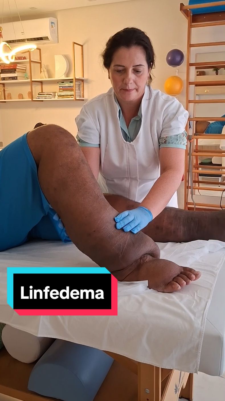 Melhora da fibrose após o início do tratamento do Linfedema com a Terapia Física Descongestiva.  #fisioterapia #descongestiva #saúde #linfedema #tratamento #controle #reabilitação #fisioterapiavascular #fy