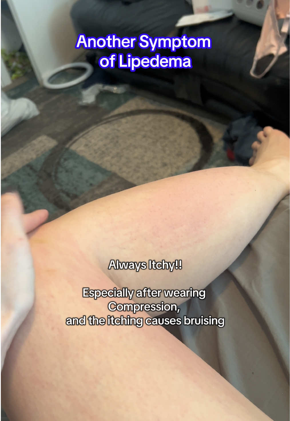 Do you get bad itching and easy bruising? Lipedema! #creatorsearchinsight #easybruising #lipedema #lipedemalegs #itching #histamineintolerance 