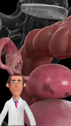 What is endometriosis?  #doctor #endometriosis 