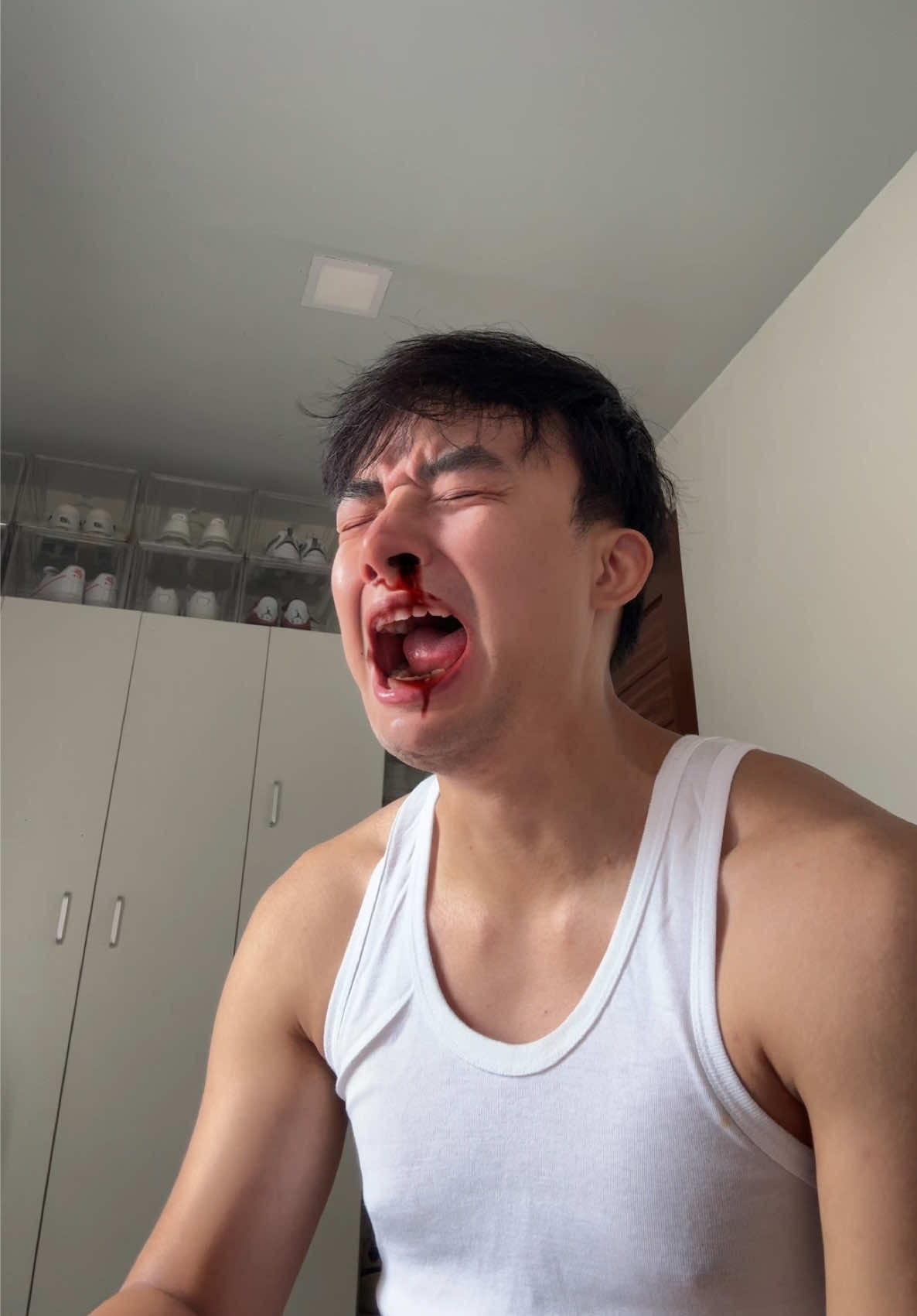 Epistaxis! #fy #fyp #foryou #nosebleed 