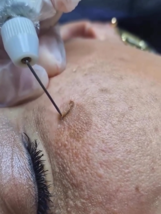 adeus manchas escuras #jatodeplasma #jatodeplasmabrasil #jatodeplasmarj #cursojatodeplasma 