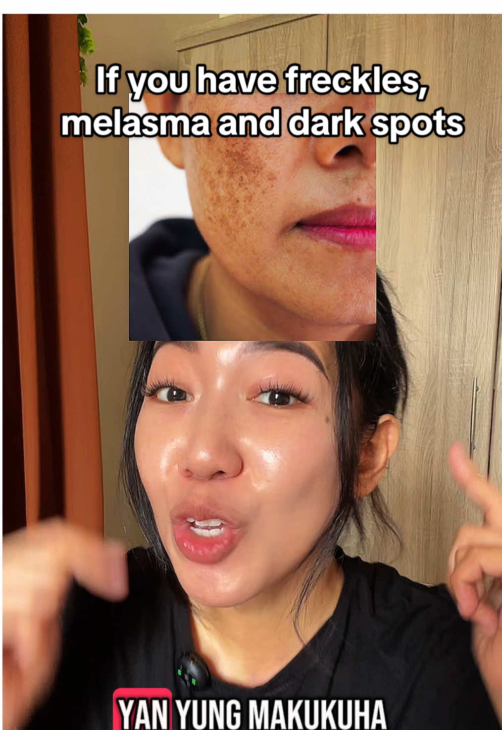 This is a must-have if you want to treat skin issues like freckles, melasma and dark spots 👌🏼 #skincare #skincareroutine #skincaretips #freckles #melasma #melasmatreatment #darkspots #healthyskin #creatorsearchinsights 