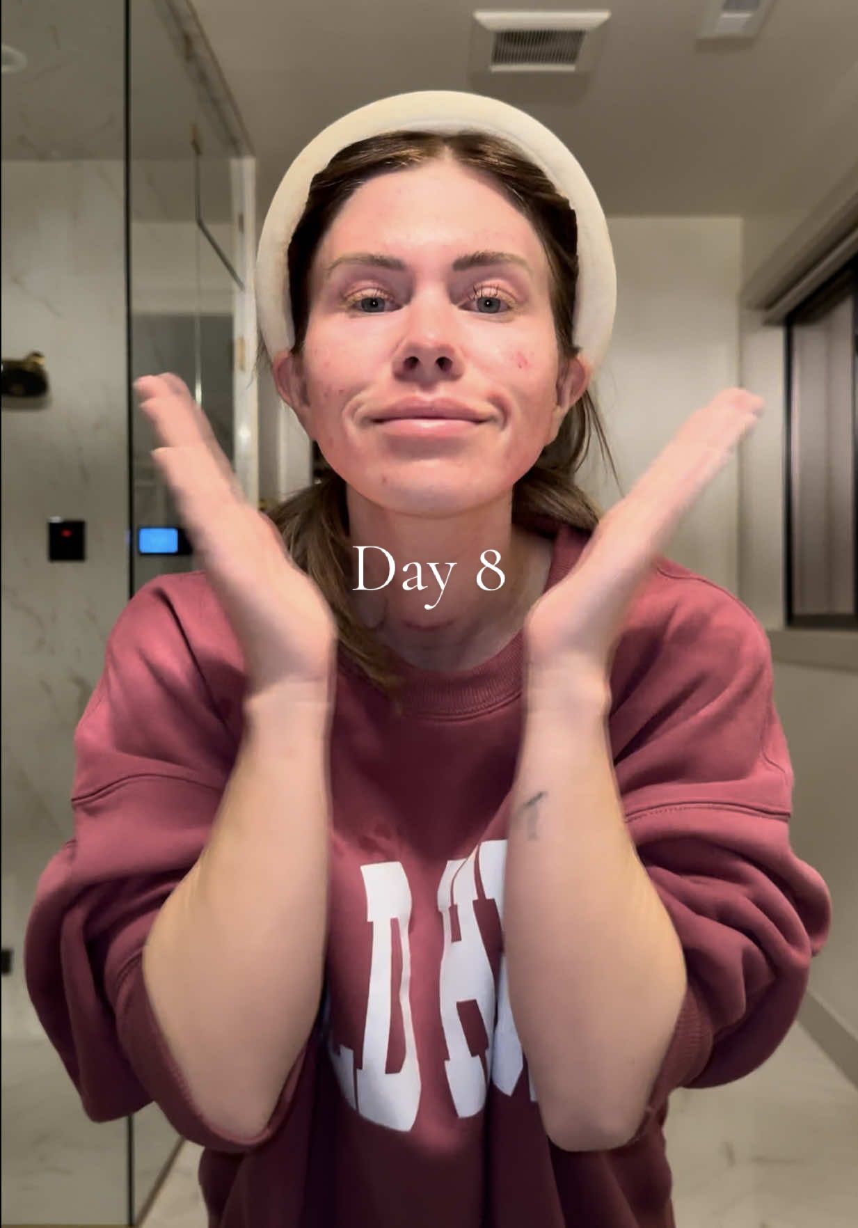 Officially one week since my #co2lasertreatment! @steele.md 