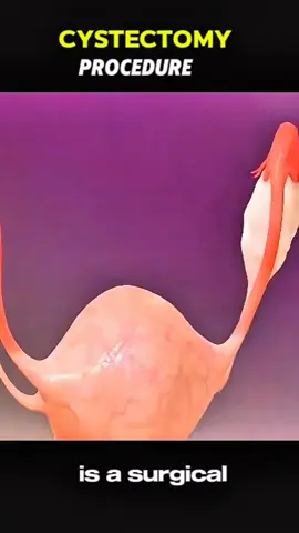 Cystectomy  #Cystectomy #BladderCancer #RadicalCystectomy #PartialCystectomy #BladderSurgery #UrinaryHealth #CystectomyRecovery #Urology #CancerTreatment #BladderHealth #RoboticCystectomy #MinimallyInvasiveSurgery #BladderRemoval #CancerAwareness #BladderCancerWarrior #CystectomyJourney #UrinaryReconstruction #Neobladder #StomaSurgery #LivingWithCystectomy 