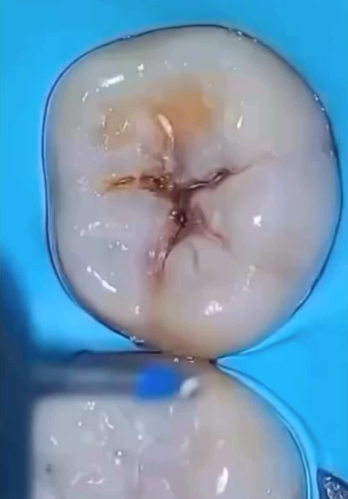 Composite Class I cusp by cusp #directcomposite #composite #dentist #dentistry #tooth #dental #fy #fyp #foryou #foryoupage #fypage #dentalstudent #fyppppppppppppppppppppppp 