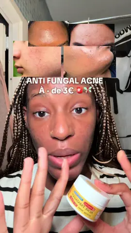 le produit est disponible sur le site iHerb « Acne Treatment Sulfur »🧚🏾‍♀️ #acnefongique #fungalacne #fungal #acne #fungalacneskincare 