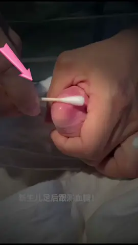 This Tiny Heel Prick Could Save a Baby’s Life! 🩺❤️ Watch as a newborn nurse carefully performs a heel prick test to screen for metabolic diseases. This simple procedure can detect health issues early, giving the baby a healthier start to life. 🌟 Are you scared of needles? Let us know in the comments! 👇 #tiktok #interesting #facts #newborn