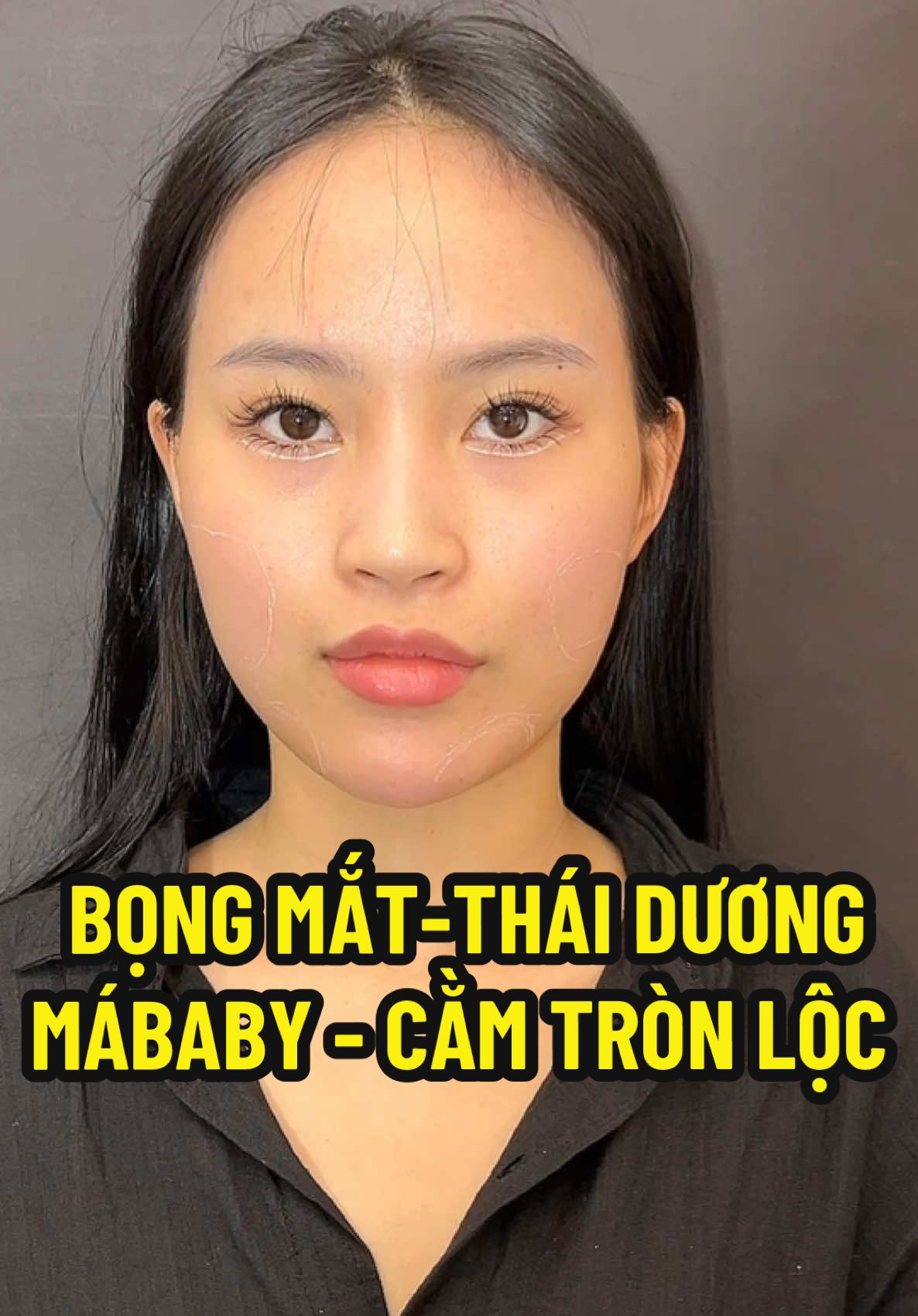 Cân chỉnh combo fullface cho em gái tổng 6CC 💓 #nganlefiller #xuhuong #tiemfillerhanoi 