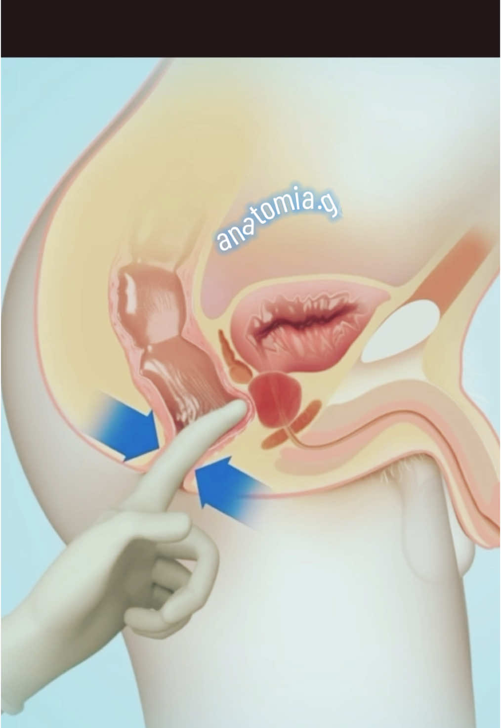 O toque retal é um exame físico realizado pelo médico para avaliar estruturas próximas ao reto, como a próstata nos homens, o reto e o assoalho pélvico em ambos os sexos. Quando é Indicado? 	•	Nos homens: principal exame para avaliar a próstata, auxiliando no diagnóstico de hiperplasia prostática benigna (HPB), prostatite e câncer de próstata. 	•	Em ambos os sexos: pode ser usado para avaliar tumores retais, hemorroidas, fissuras anais, abscessos ou sangramentos. 	•	Em emergências médicas: auxilia na investigação de obstruções intestinais e sangramentos gastrointestinais. Como é Feito o Exame? 	1.	O paciente é colocado em posição apropriada (geralmente deitado de lado com os joelhos dobrados ou em posição ginecológica). 	2.	O médico utiliza uma luva e um lubrificante para inserir o dedo indicador no reto. 	3.	O exame dura poucos segundos e pode causar um leve desconforto, mas não deve ser doloroso. 	4.	Durante o toque, o médico avalia tamanho, textura e presença de nódulos na próstata (homens) ou possíveis alterações no reto e canal anal. Importância no Diagnóstico do Câncer de Próstata 	•	Associado ao exame de PSA (Antígeno Prostático Específico), é essencial para detectar precocemente o câncer de próstata. 	•	Em caso de alterações, podem ser solicitados exames complementares, como ultrassonografia e biópsia. #toqueretal #examedotoque #cancerdeprostata #anatomy #medicine #medical #ag♿️ 