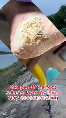 #toenails #ingrowntoenail #toenailremoval #onychomycosis #pedicure #cleaning #satisfyingvideo #asmr #usa🇺🇸 