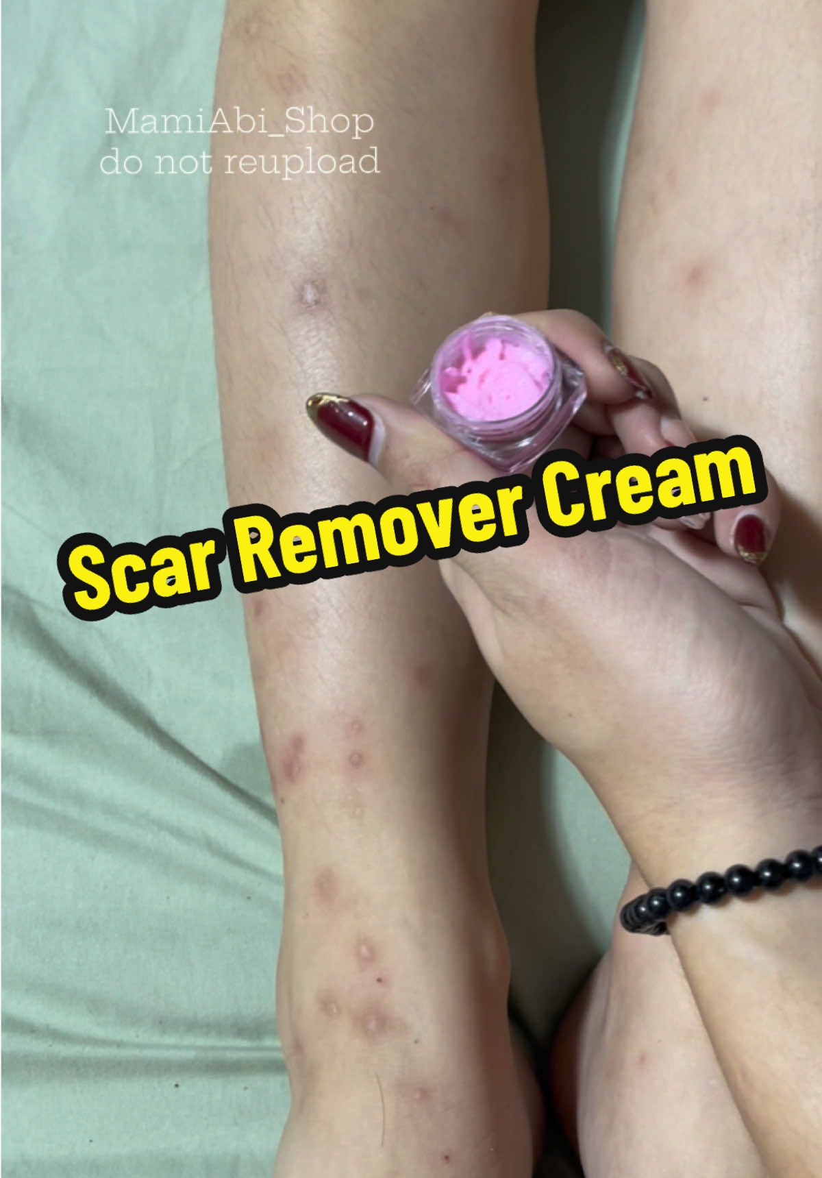 Grabe gulat ako sa result ng scar remover na to sa peklat ng anak ko 🤗 nagkaron bigla ng pag asa 🥰 thank you Scar Remover Cream 🤗 #scarremoval #scarremovercream #scarremover 