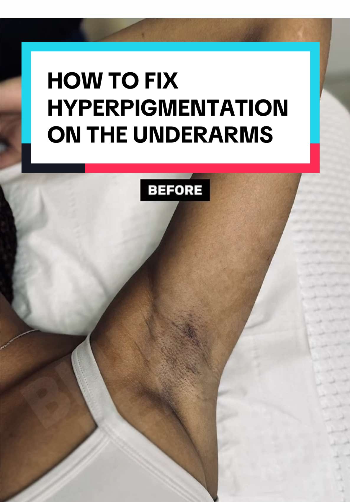 HOW TO FIX DARK ARMPITS FOR BLACK SKIN 😍😇 For black skin, Pico and IPL work together to safely and effectively treat underarm hyperpigmentation. Pico laser precisely targets deep melanin clusters without overheating the skin, minimizing the risk of post-inflammatory hyperpigmentation (PIH). IPL, when used with the right settings for darker skin, helps fade surface pigmentation and boosts collagen for smoother, more even-toned skin. Together, they provide a balanced approach, with Pico breaking down stubborn pigment and IPL enhancing overall brightness and skin texture. #hyperpigmentation #underarms #darkspots #darkmarks #skincare #ipl #picolaser #pico #darkskin #black #blackskin #london #fyp #viral 