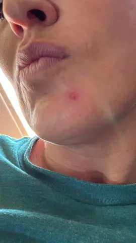 #creatorsearchinsights #skincarejourney #GlowUp #acne #allnaturalskincare  I have worked extremely hard to get my skin clear and where I want it to be. It’s always going to take work and dedication, but having my skincare line has been a saving grace. I’m so thankful to be able to get rid of painful acne and heal my skin from the inside out!! @The Urban Skin 