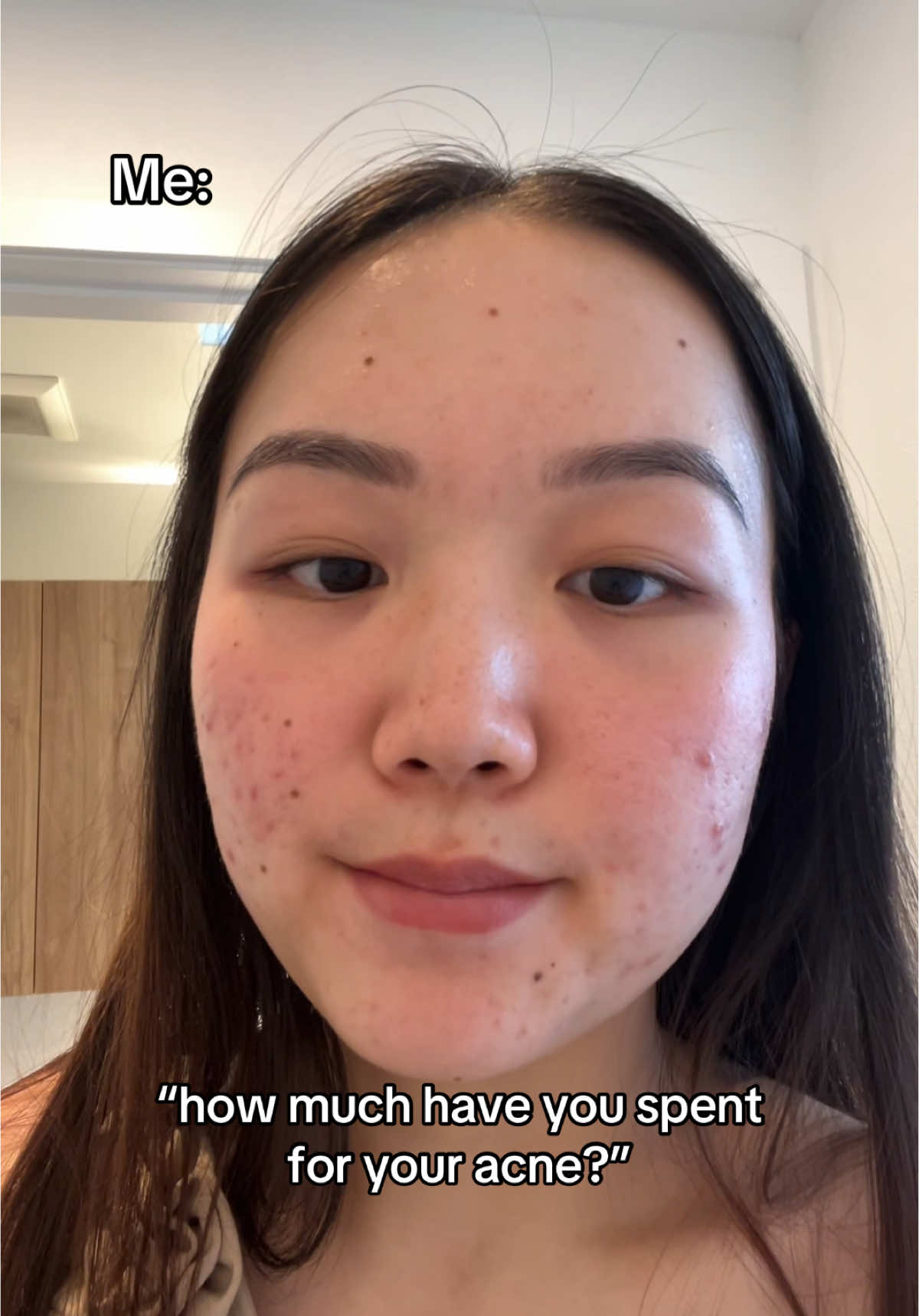 Having acne = 💸🫠 #acne #relatable #viral #girlhood #clearskin #dermatologist 