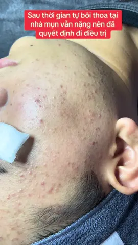 Lại nhận ca đtri Mụn mới ☺️ #ĐiềuTrịMụn #peelmesotherapy #Tànnhang #điềutridachuanykhoa #goclamdep #đaotaohocvienchuyennghiep #tưvanlamdep 