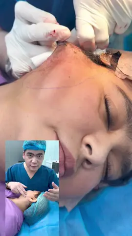 Repair old scars for customers performed at other facilities  #drlee #fullfacelift #tiktokviral #videoviral 