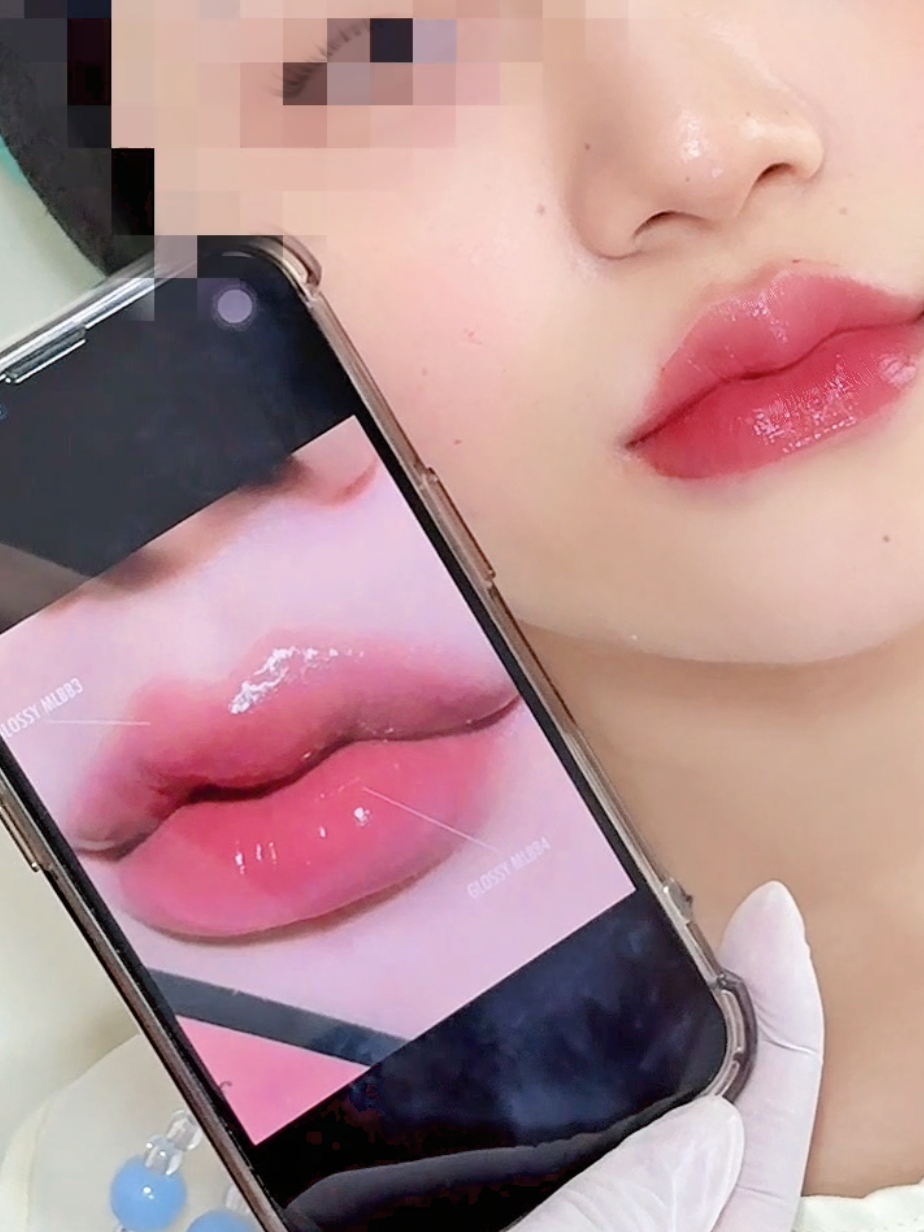ฟิลเลอร์ปาก Nueramis Volume 🎀 #คลินิกหาดใหญ่ #ลูกสาวฟลอเรส #ฟิลเลอร์ #ฟีดดดシ #ฟิลเลอร์หาดใหญ่ #นิวรามิส #neuramisvolume #ฉีดปากหาดใหญ่ #ฉีดหน้าหาดใหญ่ 