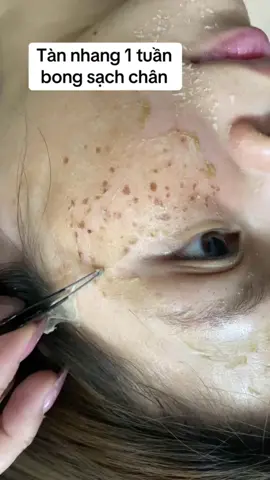 7-10 ngày bong sạch tàn nhang #làmđẹp #trịtànnhangtạinhà #xuhuongtiktok #táitạo #pell #thâm #pellnám #bong #xuhướng #yody #yodyphươnganh #táitạoda #yodyphuonganh #tànnhang #táitạoda 