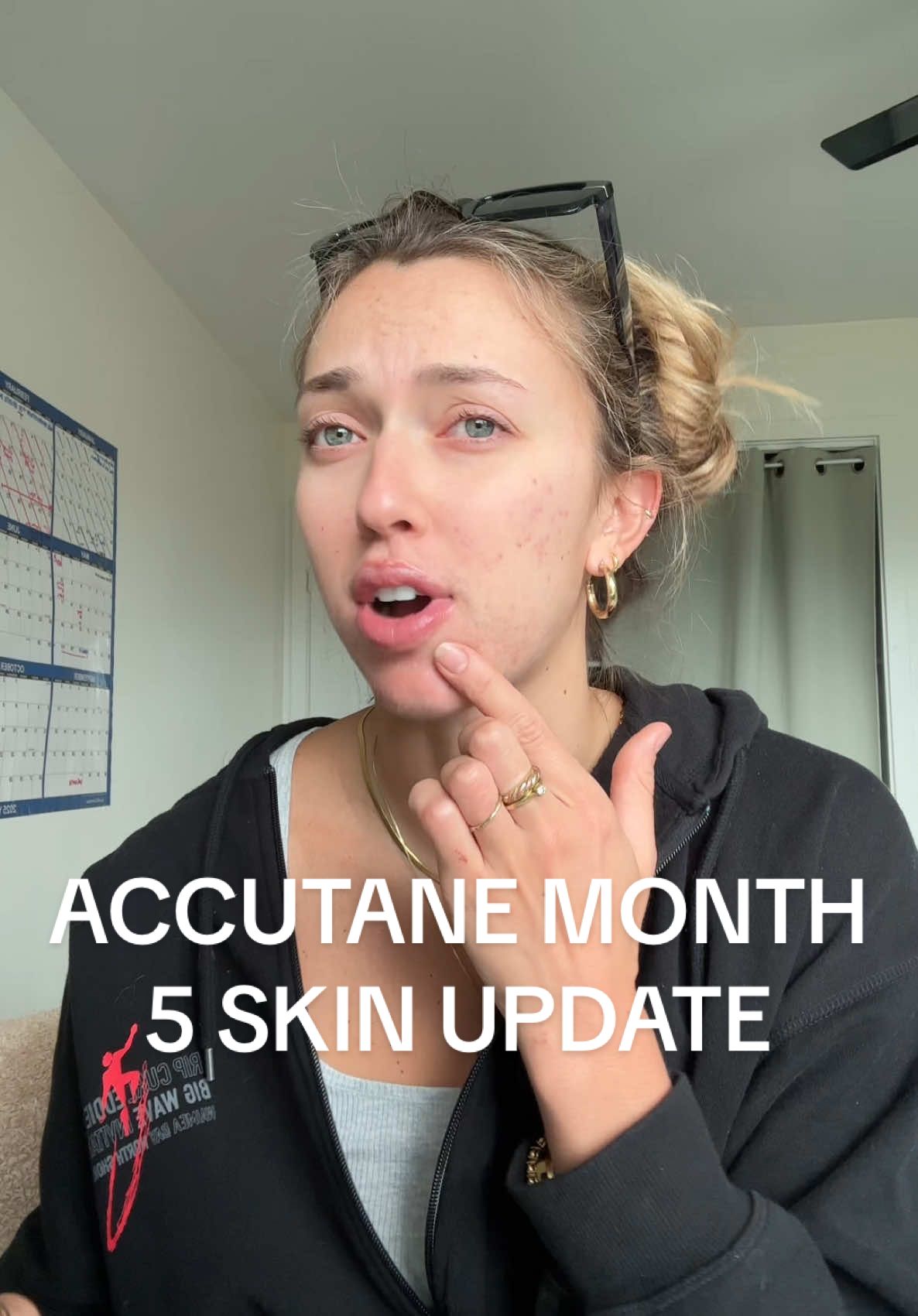 we are back I missed u guys also come back later for first round of giveaway announcements🏄‍♀️🏄‍♀️🏄‍♀️ #accutane #accutanejourney #accutanecheck #accutanepurge #acne #acneskin #acneskincareroutine #acneskintreatment #acneskincare #acneproneskin #acnefighter #acnecheck 